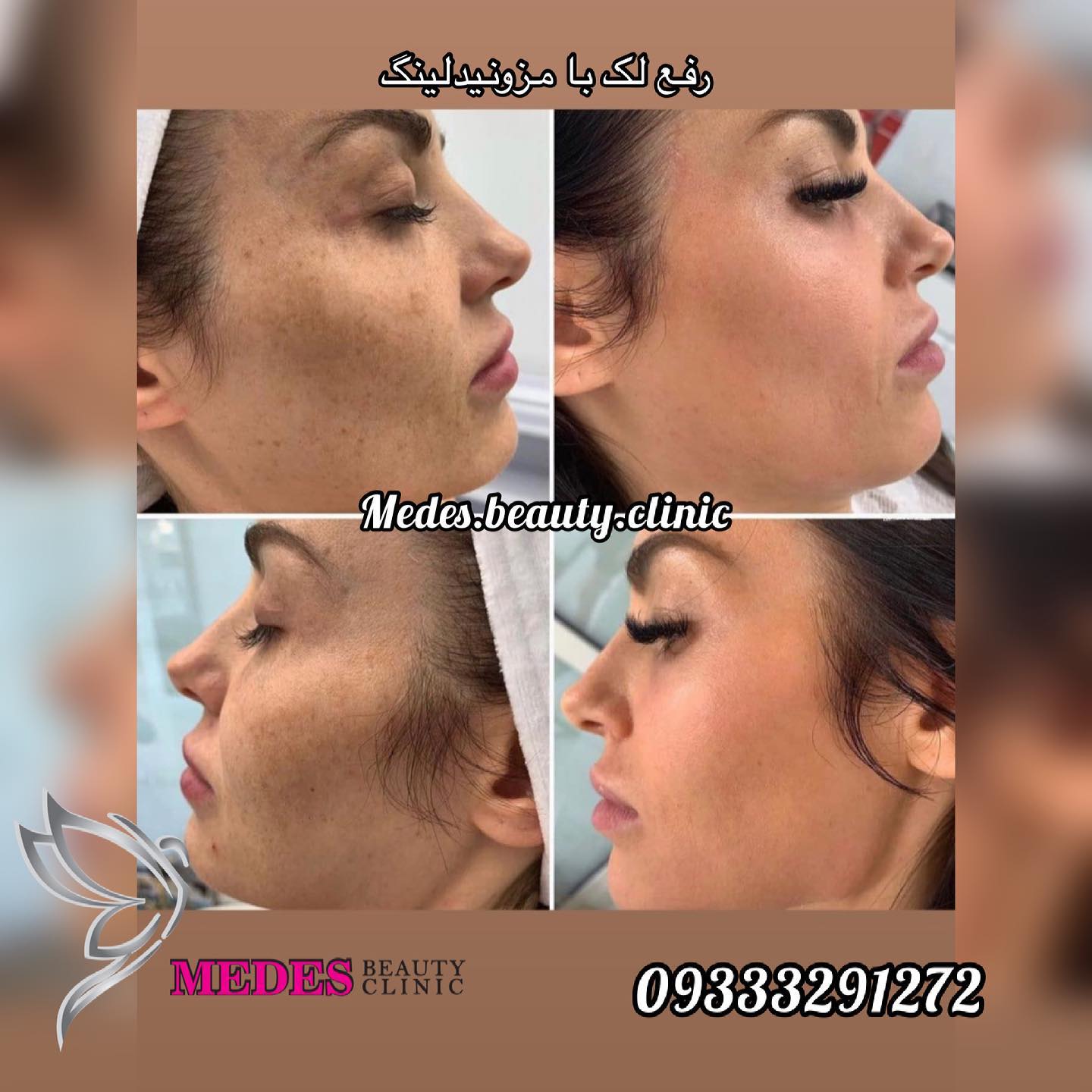 گالری مزونیدلینگ